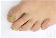 治疗灰指甲的偏方都有什么？