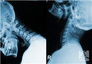 颈椎引起的眩晕是怎么回事?