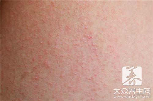 红霉素软膏能不能治疗湿疹